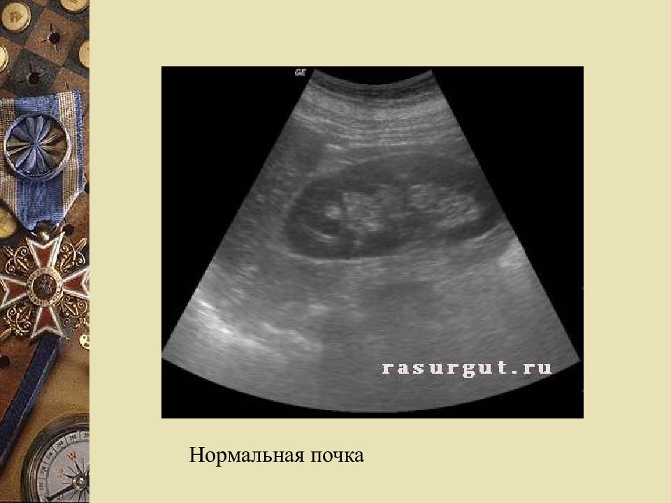 Нормальная почка. УЗИ почек острый пиелонефрит. Хронический пиелонефрит по УЗИ. УЗИ почек при остром пиелонефрите. Острый пиелонефрит по УЗИ.