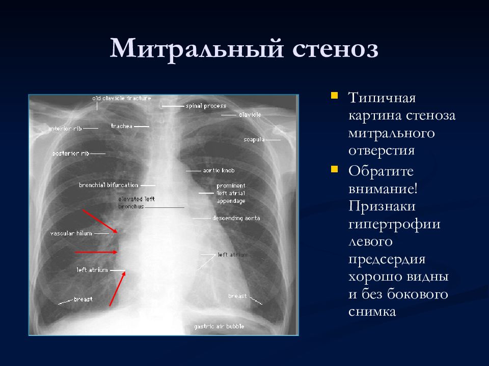 Ампутация корней легких при рентгенологической картине характерна для