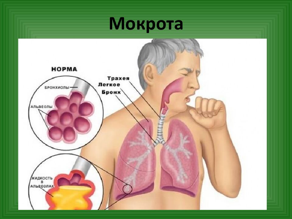 Мокрота