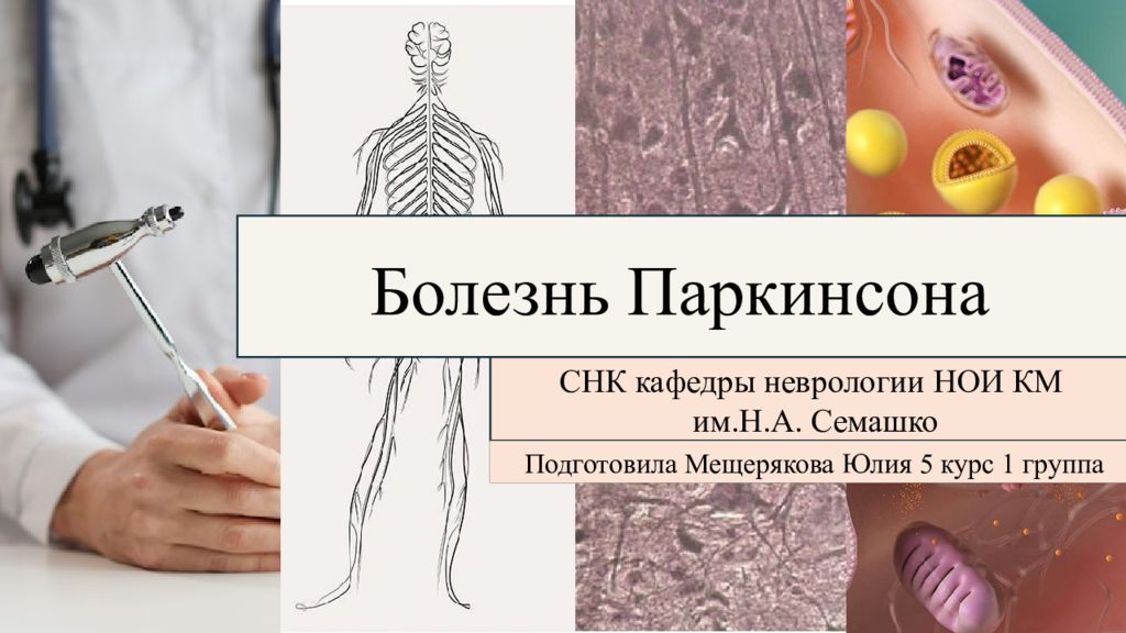Болезнь Паркинсона СНК кафедры неврологии НОИ КМ им.Н.А. Семашко Подготовила