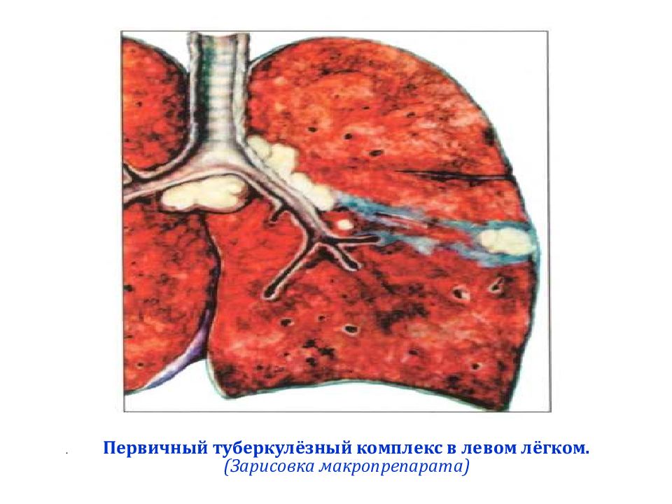 Первичный туберкулезный комплекс презентация