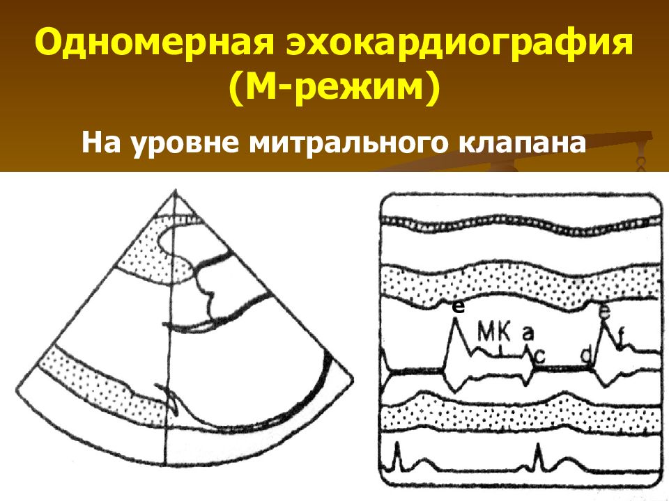 М режим. Одномерная эхокардиография. М режим митрального клапана. Эхокардиография одномерный режим. М-режим эхокардиографии.