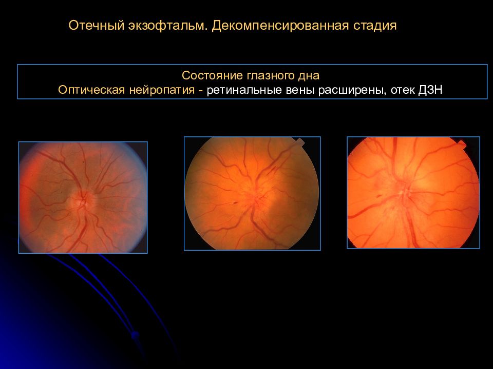 Нейропатия зрительных. Нейрооптикопатия зрительного нерва. Декомпенсированный отёчный экзофтальм. Оптическая нейропатия глаза. Передняя ишемическая нейропатия зрительного.