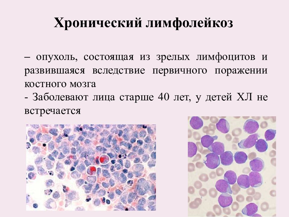 Хронический лимфолейкоз презентация