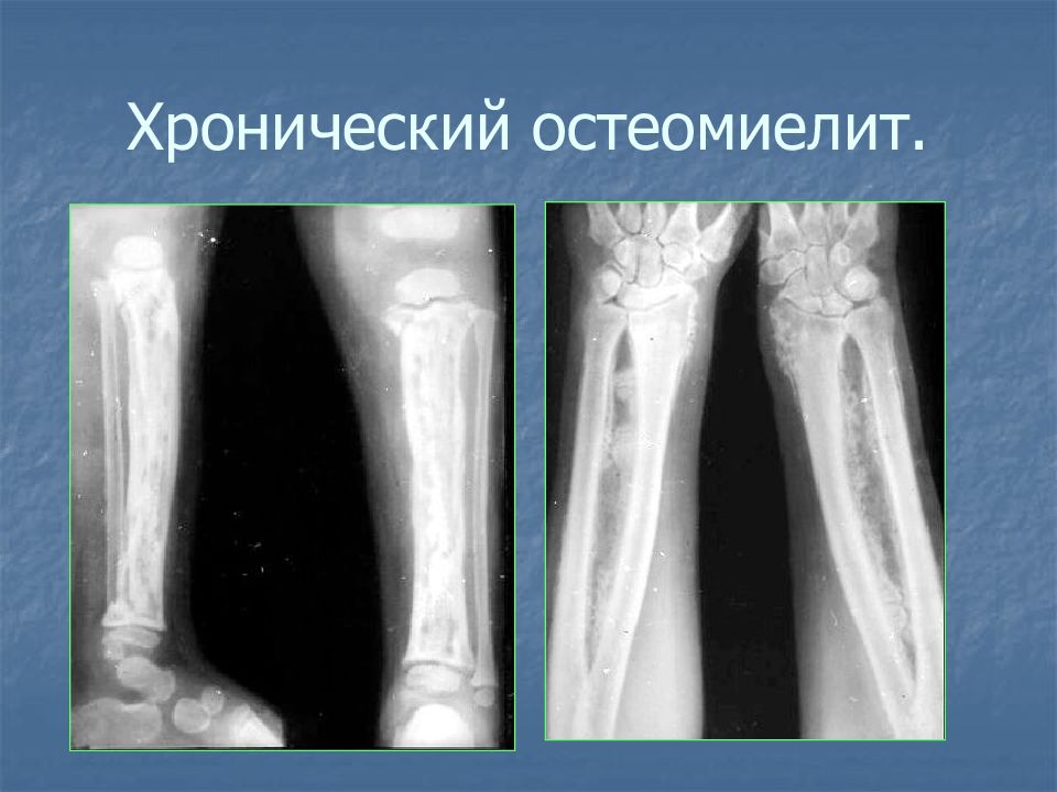 Хронический остеомиелит. Хронический остеомиелит секвестр. Негнойному остеомиелит. Остеомиелит лучевой кости. Остеомиелит трубчатых костей.