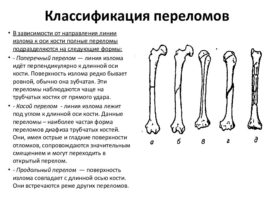 Тест переломы костей. Классификация смещения отломков при переломах трубчатых костей.. Классификация переломов со смещением. Классификация переломов костей-таблица. Классификация переломов длинных трубчатых костей.