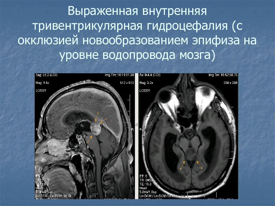 Выражено умеренно гидроцефалия мозга. Гидроцефалия головного мозга на кт. Окклюзионная гидроцефалия головного мозга кт. Наружная гидроцефалия головного мозга кт. Открытая гидроцефалия головного мозга кт.