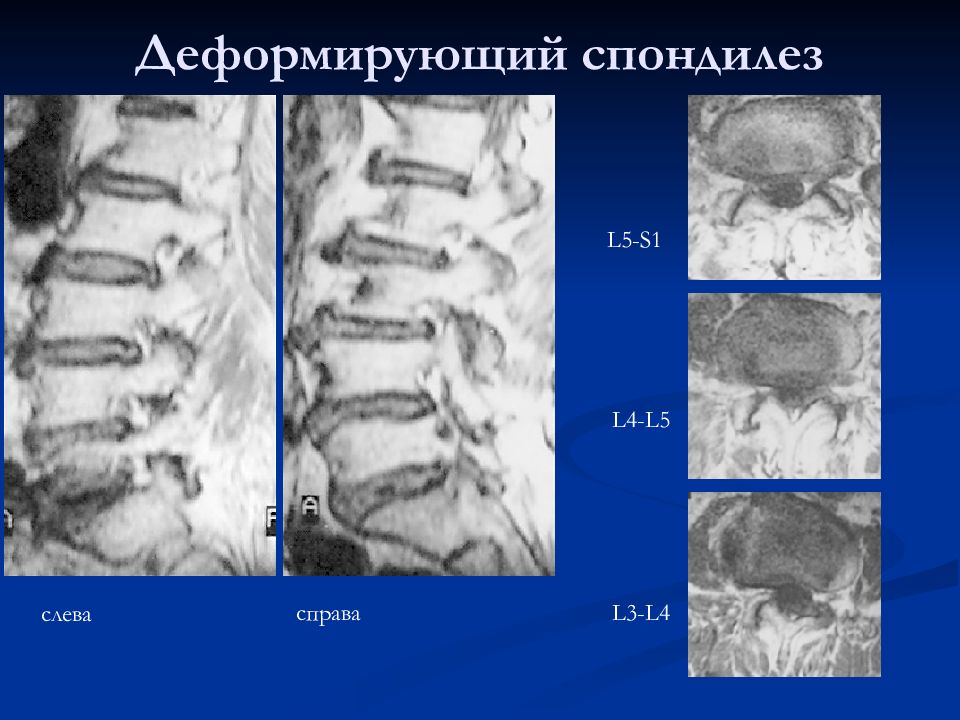 Деформирующий спондилез фото