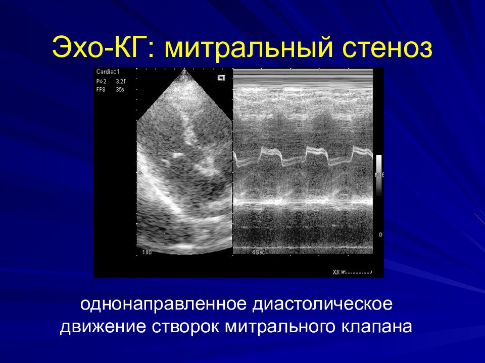 Митральный стеноз картинка