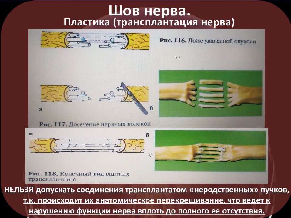 Нерв пила. Пластика периферических нервов.