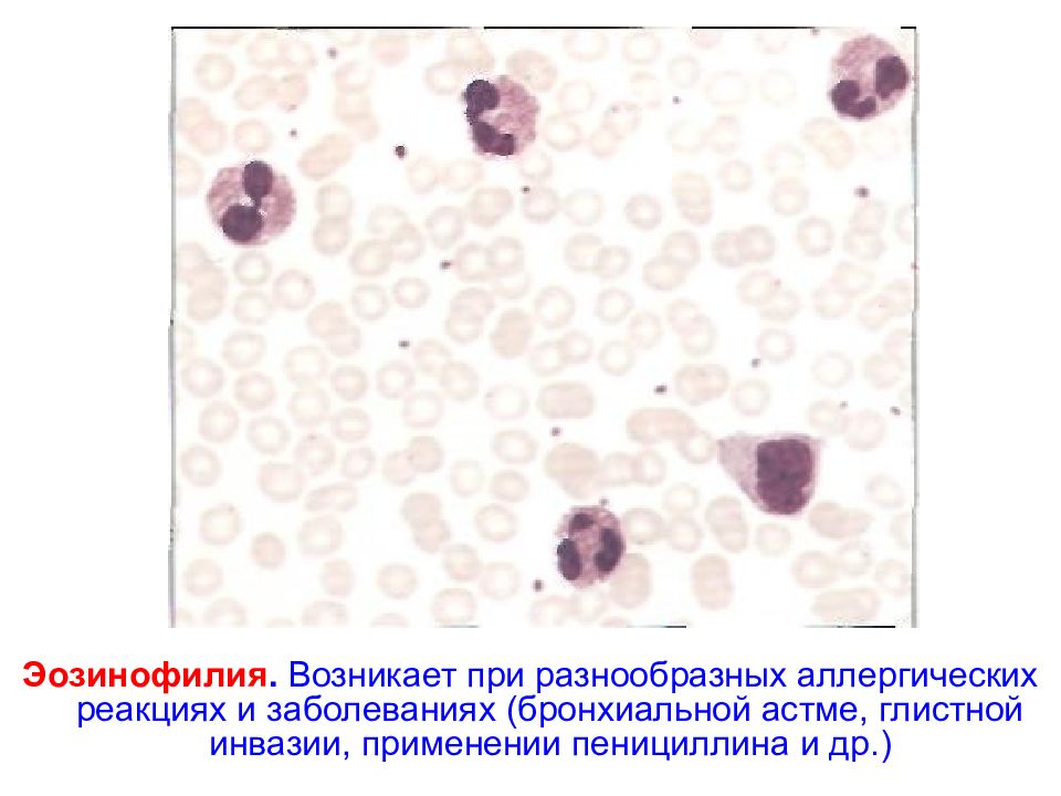 Эозинофильный лейкоцитоз. Эозинофилия периферической крови. Эозинофилия картина крови. Эозинофильный лейкоцитоз картина крови.