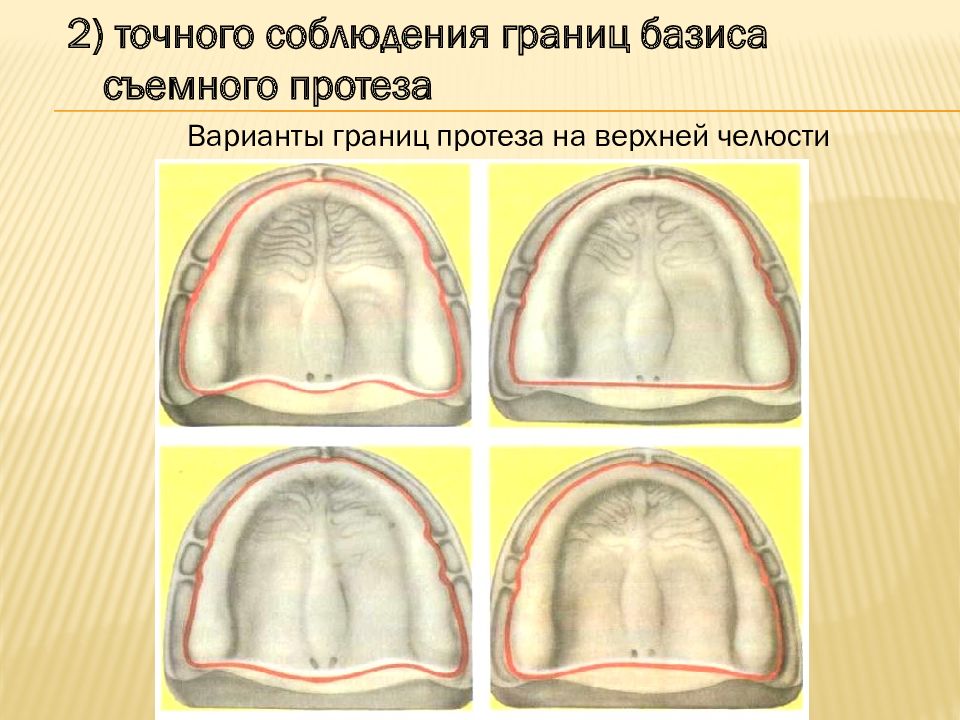 Отсутствовать полость. Границы базиса протеза на беззубой челюсти. Граница базиса протеза на нижней челюсти. Строение беззубой верхней челюсти. Границы базиса съемного протеза.