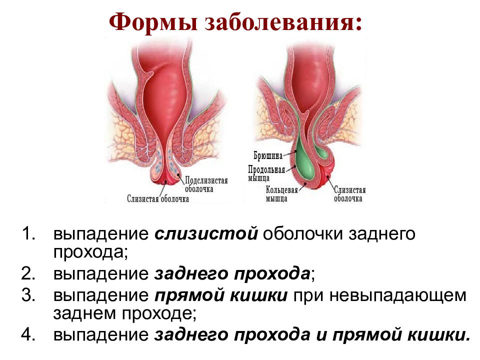 Презентация операции на прямой кишке