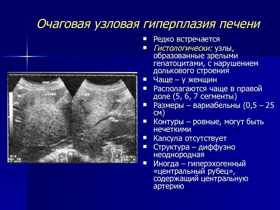 Очаговое поражение печени. Очаговые поражения печени. Классификация очаговых поражений печени. Солидная структура на УЗИ. Лучевая диагностика очаговых заболеваний печени..