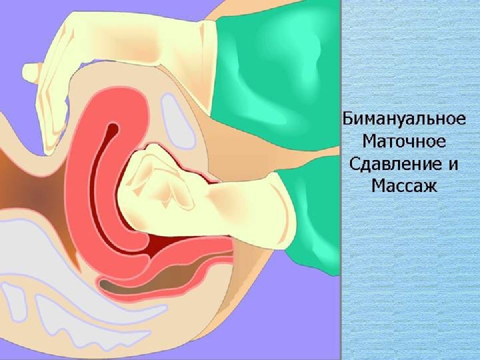 Массаж матки. Retroflexio матка. Загиб матки ретрофлексия. Массаж матки гинекологический. Гинекологический масс.