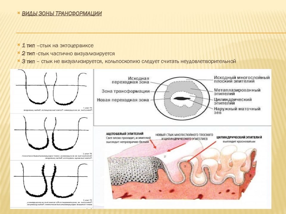 Зона трансформации 3 типа. Кольпоскопия зона трансформации 1 Тип. Зона трансформации шейки матки 1 Тип. Зона трансформации шейки 1 типа. Нормальная кольпоскопическая картина (зона трансформации).