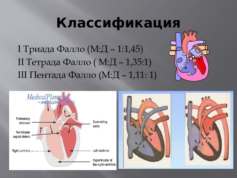 Врожденный порок сердца тетрада фалло презентация