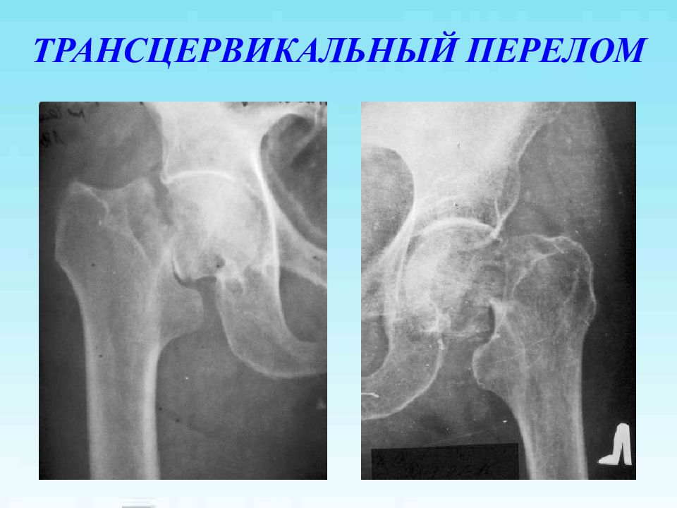 Перелом шейки бедра презентация