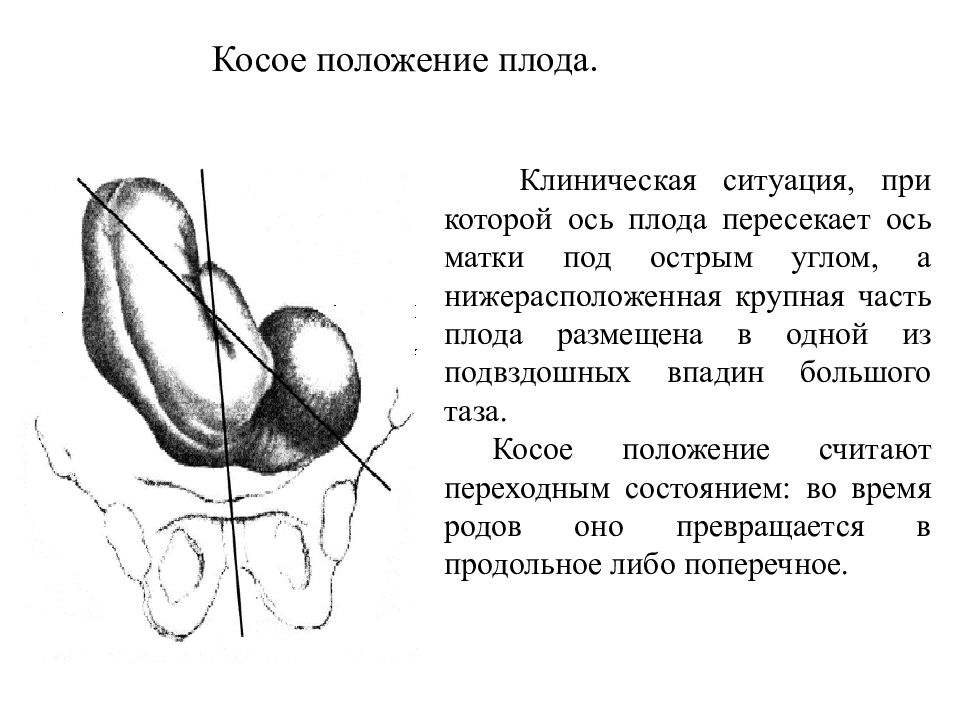 Косое и поперечное положение плода презентация