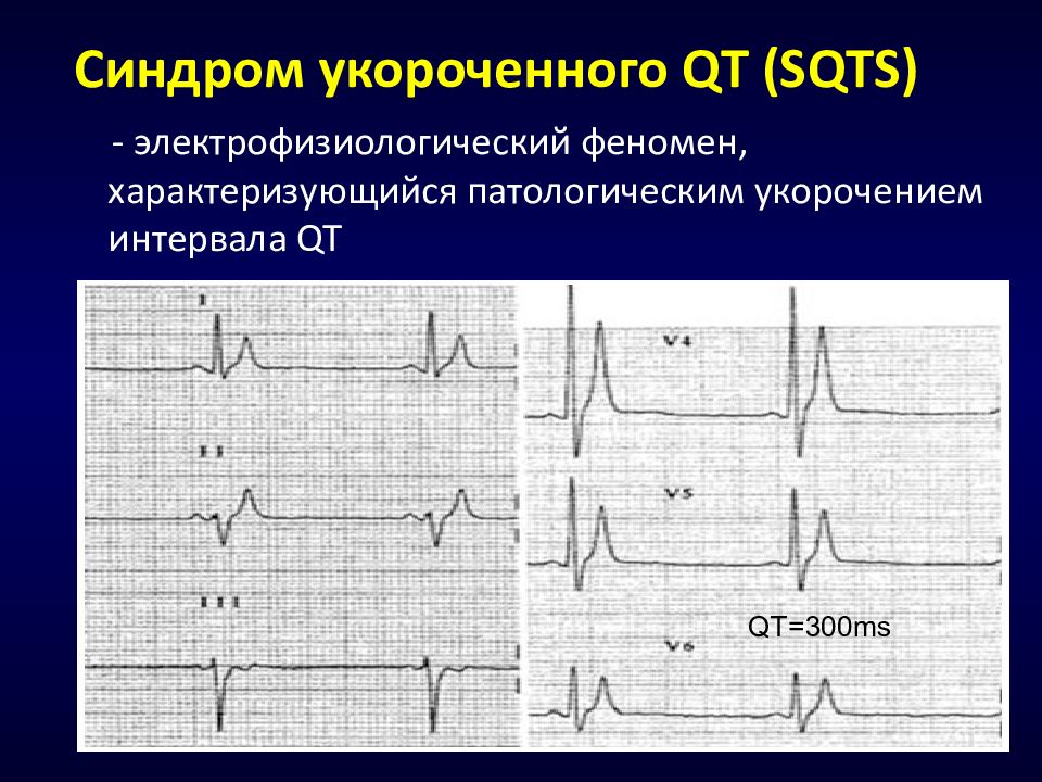 Феномен укороченного pq