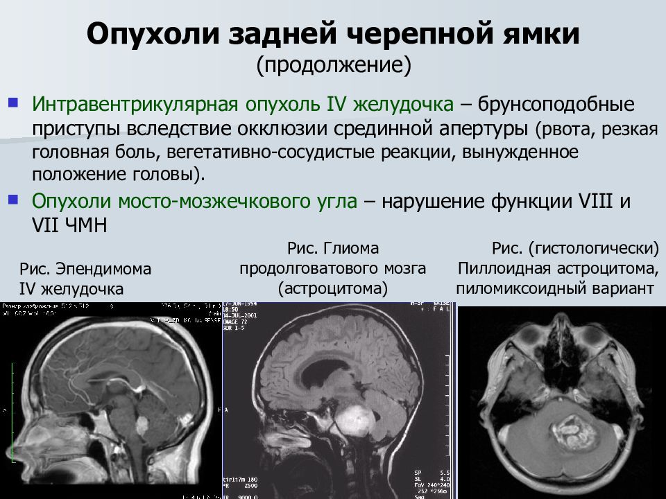 Диагноз опухоли головного. Диагностические критерии глиомы головного мозга. Объемное образование головного мозга. Локализация опухолей головного мозга. Первичные и вторичные опухоли головного мозга.