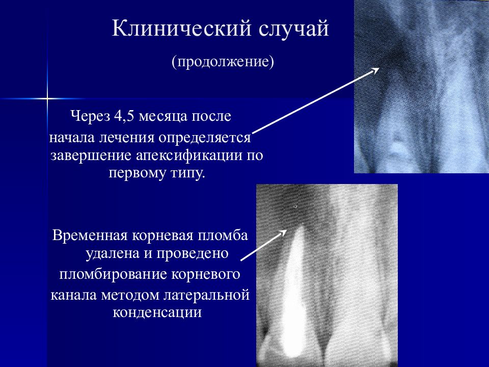 Апексогенез и апексификация. Апексификация и апексогенез в стоматологии. Апексогенез методика проведения.