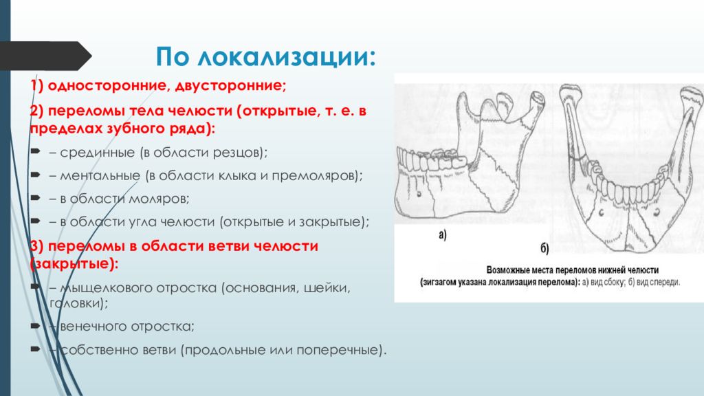 Лечение нижней челюсти. Классификация переломов нижней челюсти рентген. Механизм смещения отломков при переломах нижней челюсти. Классификация перелом нижней челюсти рентгенологические. Ментальный перелом нижней челюсти схема.