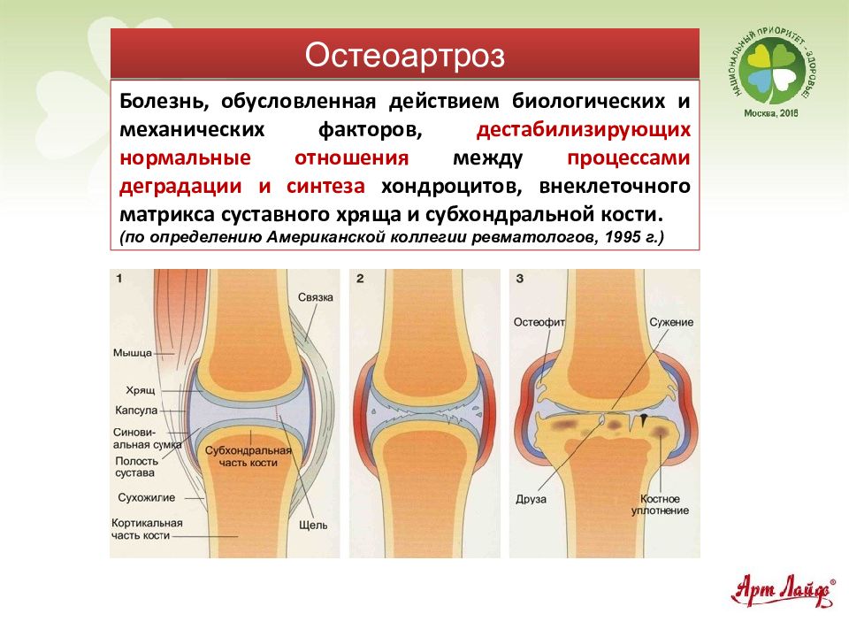 Наиболее яркая картина синовита с частыми обострениями наблюдается при остеоартрозе