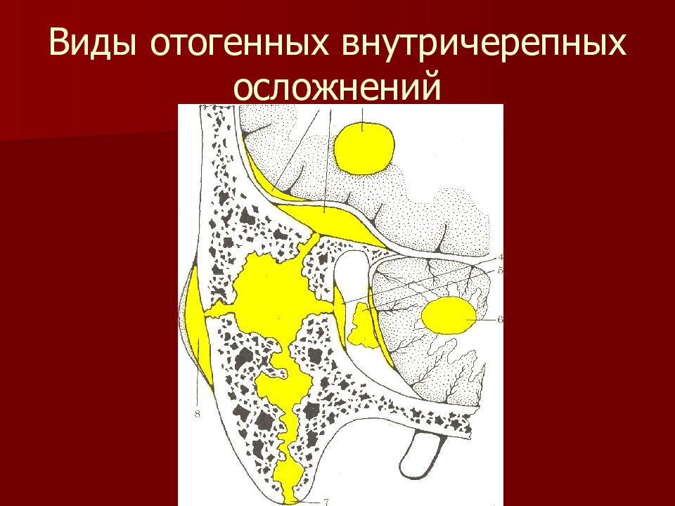 отогенные осложнения оториноларингология. отогенный абсцесс височной доли мозга. отточенные внутричерепные осложнения. отогенные осложнения. отогенные внутричерепные осложнения.