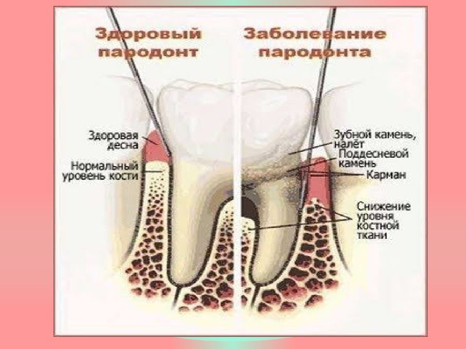Понятие о пародонтальном комплексе особенности функционирования и биомеханики пародонта презентация