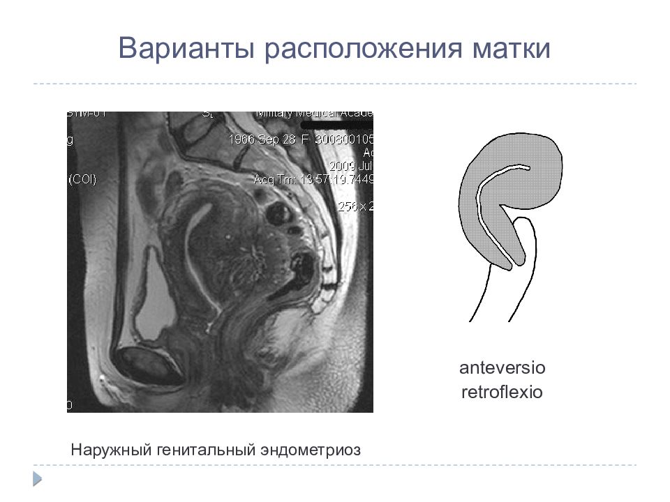 Расположение матки. Anteversio Flexio матки. Положение тела матки. Варианты расположения матки. Расположение матки anteversio.