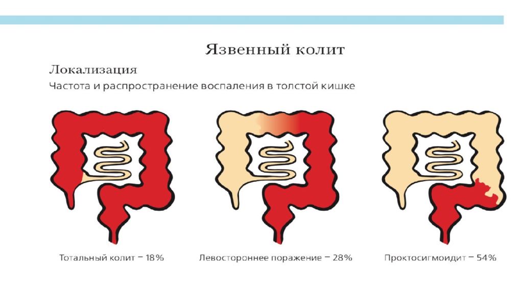 Взк рф. Воспалительные заболевания кишечника классификация. Презентация хронические заболевания кишечника. Воспалительные заболевания кишечника Федоров. Воспалительные заболевания кишечника 19 мая.