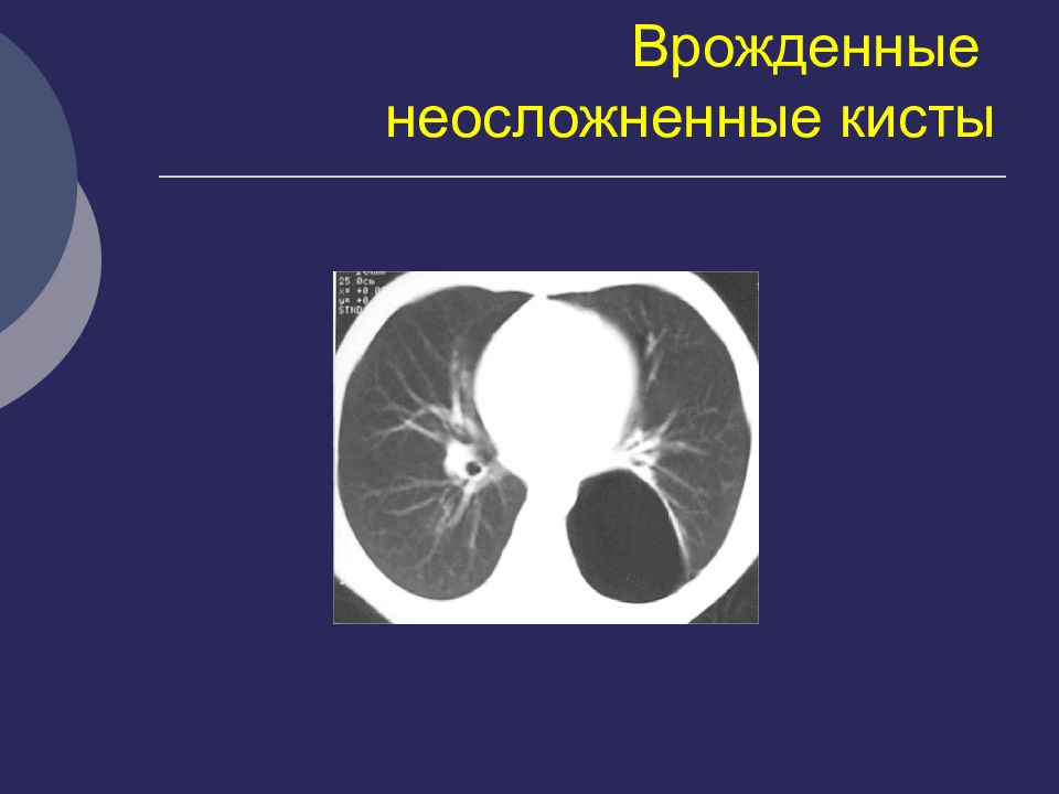 Кисты легких у детей презентация