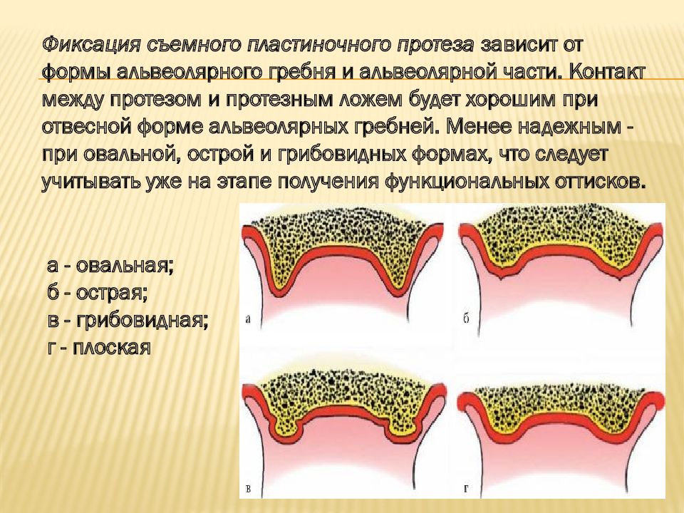 Альвеолярный гребень нижней. Формы альвеолярного гребня. Формы альвеолярного отростка. Припасовка и наложение полных съемных протезов. Степени атрофии альвеолярного отростка.