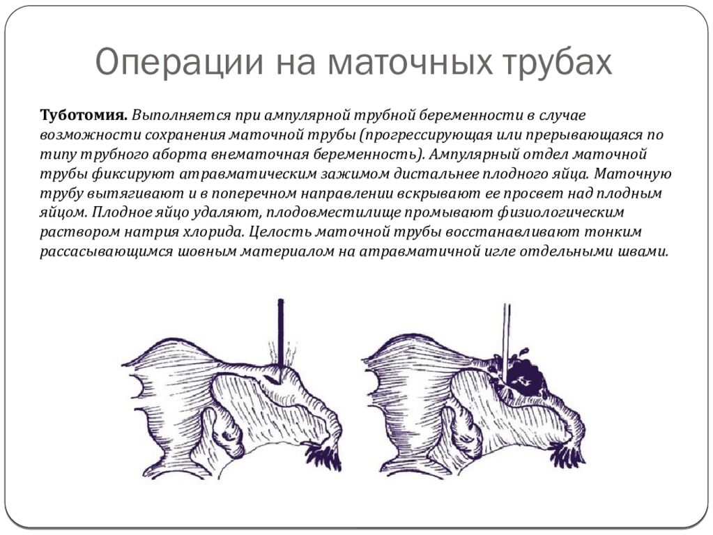 Сколько труб у женщины. Резекция маточной трубы. Операции на маточных трубах. Удаление маточной трубы.