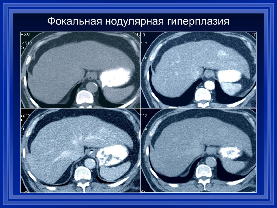 Фнг печени. Нодулярная гиперплазия печени на кт. Узловая гиперплазия печени кт. Нодулярная Узловая гиперплазия печени. Фокальная нодулярная гиперплазия печени кт.