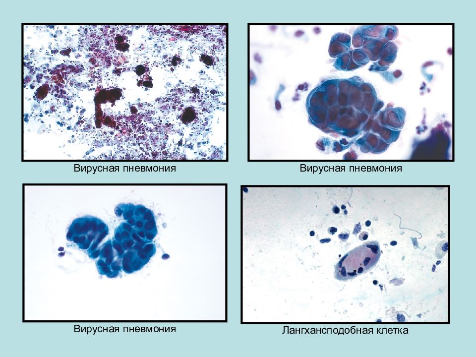 Вирус пневмонии. Вирусная пневмония. Вирусная пневмония диагностика. Цитологическая диагностика презентация. Цитологическая диагностика заболеваний дыхательных путей и легких.