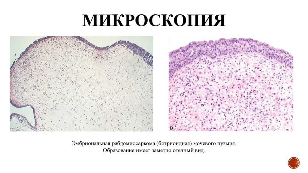 Эмбриональная рабдомиосаркома. Папиллома кожи микропрепарат патанатомия. Эмбриональная рабдомиосаркома гистология. Альвеолярная рабдомиосаркома гистология. Рабдомиосаркома мочевого пузыря гистология.