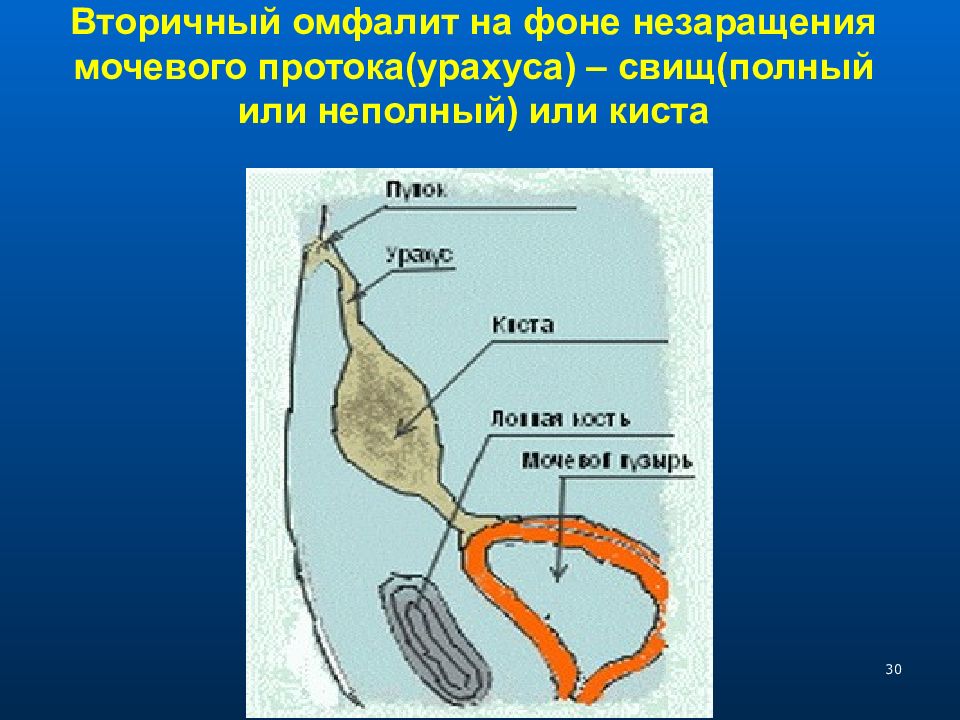 Урогенитальные свищи. Киста урахуса операция.