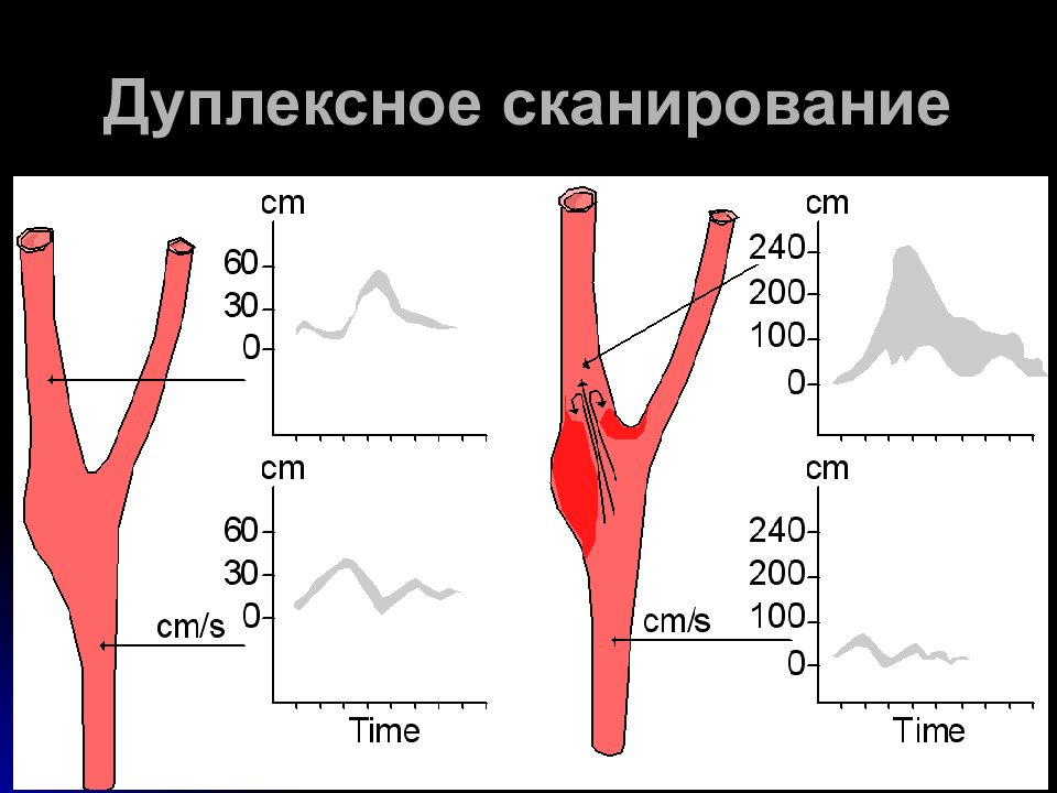 Дуплексное сканирование аорты. УЗИ аорты и ее ветвей. Дуплексное сканирование ветвей дуги аорты. Дуплексное сканирование аорты протокол исследования.