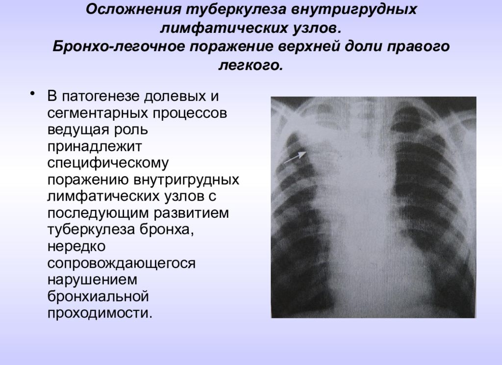 Лимфоузлы в легких причины. Осложнения туберкулеза внутригрудных лимфоузлов. Симптомы туберкулез лимфатических внутригрудных. Туберкулез внутригрудных лимфатических диагностика. Туморозный туберкулез внутригрудных лимфатических узлов.
