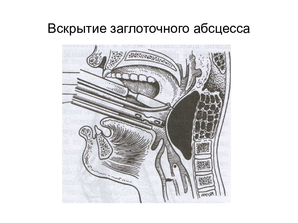 Заглоточный абсцесс. Позадиглоточный абсцесс. Абсцесс заглоточного пространства. Вскрытие ретрофарингеальных флегмон и абсцессов.. Вскрытие заглоточного абсцесса.