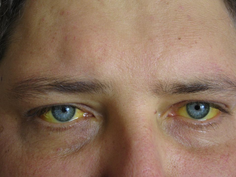 Желтый человек какая болезнь. Желтые глаза при циррозе. Желтушность кожных покровов.