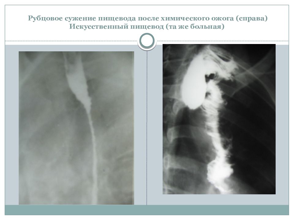 Химические ожоги пищевода презентация