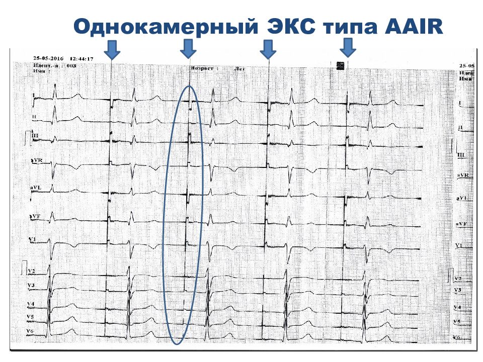 Ex type. Экс на ЭКГ. Каналы ЭКГ. Однокамерной DDDR ЭКГ. Экс DDDR на ЭКГ.
