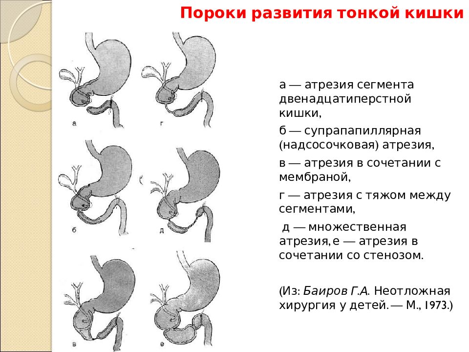 Развитие 12. Классификация атрезии кишечника. Атрезия тонкого кишечника классификация. Атрезия 12 перстной кишки классификация.