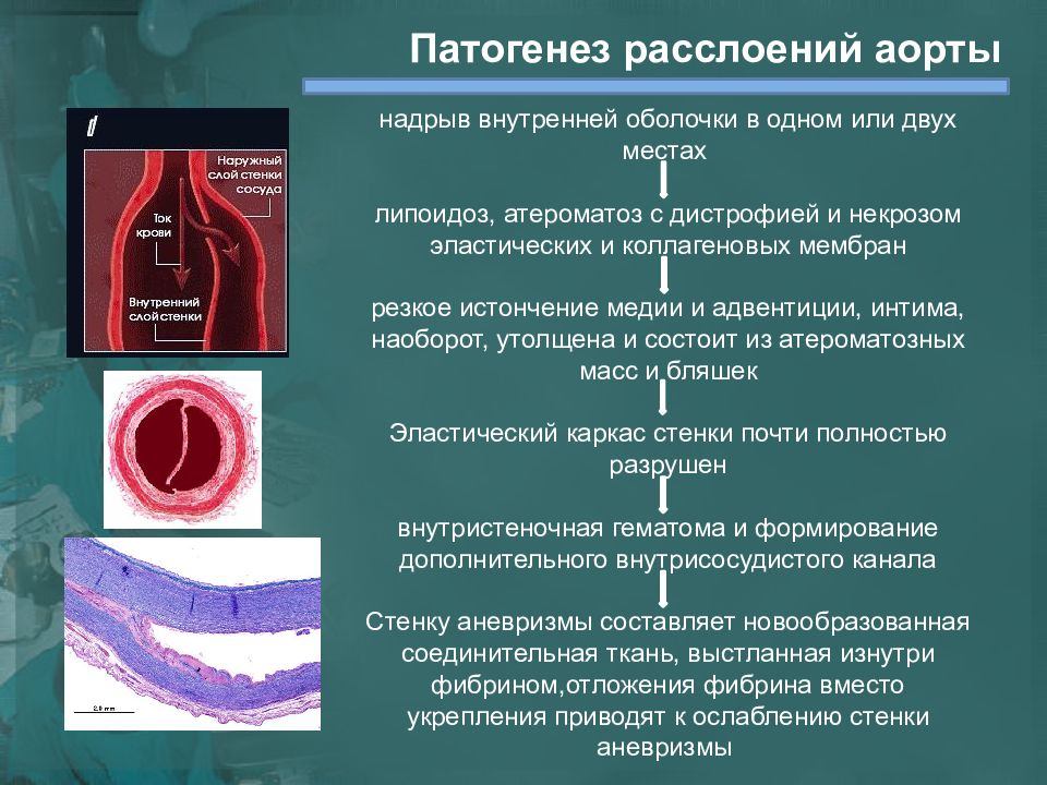 Диагностика аорты