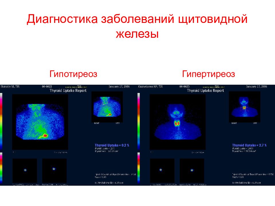 Диагностика щитовидной железы. Радиоизотопное исследование щитовидной железы. Радионуклидные методы исследования щитовидной железы. Динамическая радионуклидная сцинтиграфия головного мозга. Сцинтиграфическое исследование щитовидной железы.