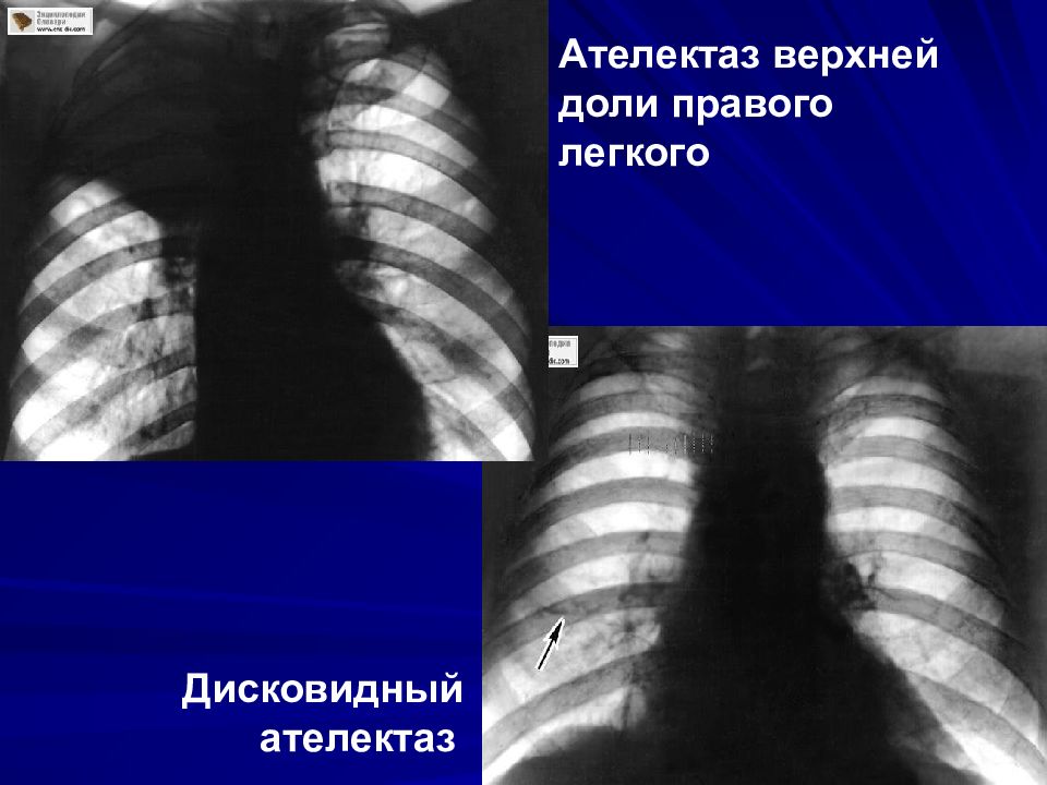 Дисковидные ателектазы рентген. Ателектаз нижней доли правого легкого рентген. Ателектаз верхней доли справа рентген. Дисковидный ателектаз. Изменения в верхней доле легкого