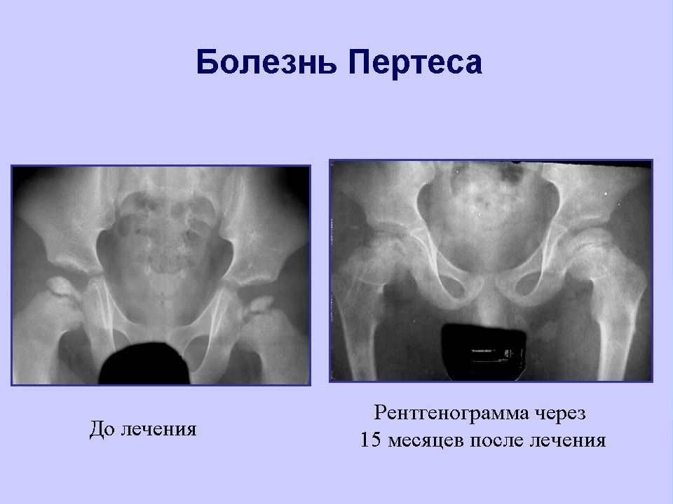 Презентация болезнь пертеса